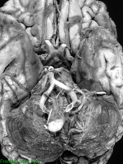 Superficial siderosis, ventral surface of brain.